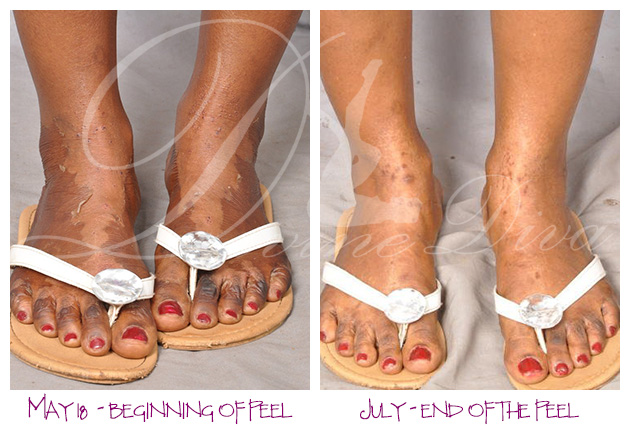 feet peel before and after